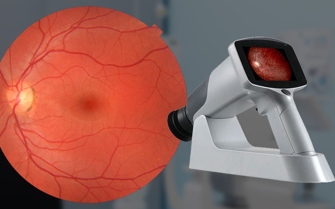 Fundus Camera